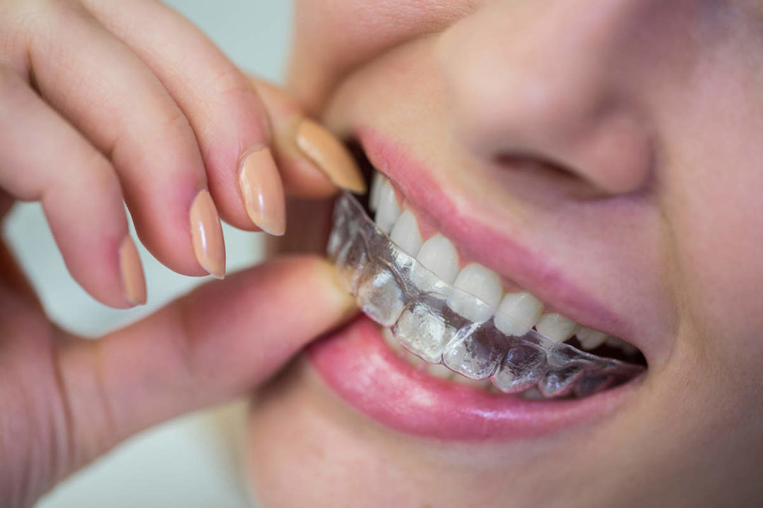  La ortodoncia invisible como la nueva tendencia en el cuidado dental 